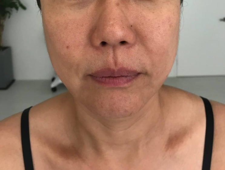  비포앤애프터 온다. 써마지. 리포스타 후기