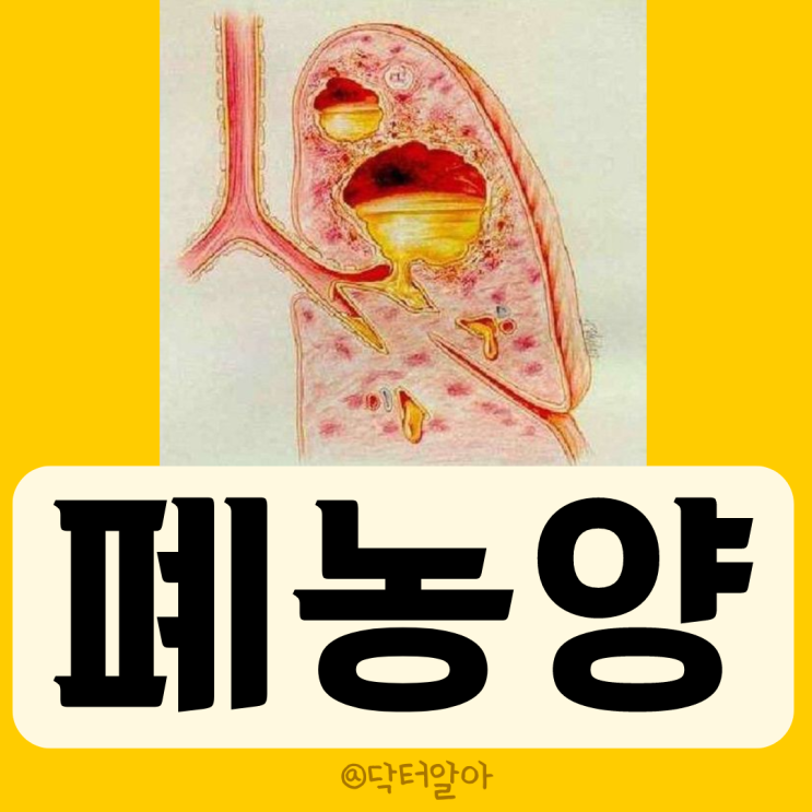  폐 농양 (lung abscess)의 정의, 증상, 진단 및 치료