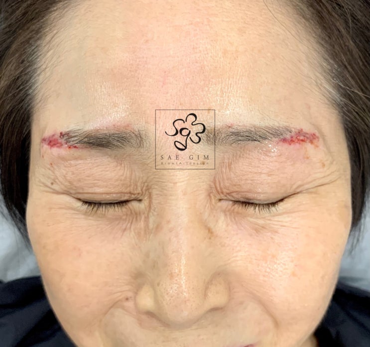  경산 눈썹문신 잔흔제거 이렇게하면 큰일납니다