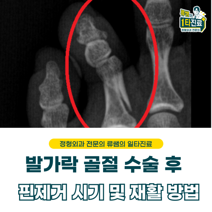  발가락 골절 수술 이후 핀 제거 시기 및 재활 치료  (의사작성)