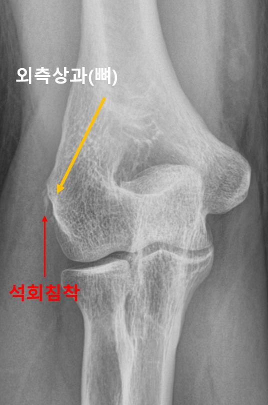  광주 신경외과, 테니스 엘보 원인? 병원을 다시 찾은 이유