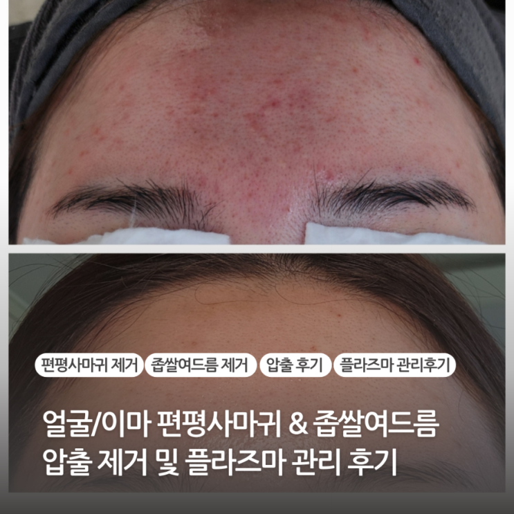  얼굴 편평사마귀 이마 좁쌀여드름 제거 (압출, 플라즈마, 제거후기, 제거 후 관리)