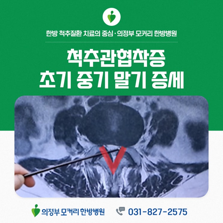  의정부모커리한방병원 허리 협착증 초기 중기 말기 증세