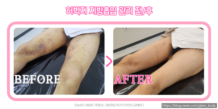  허벅지 지방흡입 후 한달간 회복과정 전후 비교