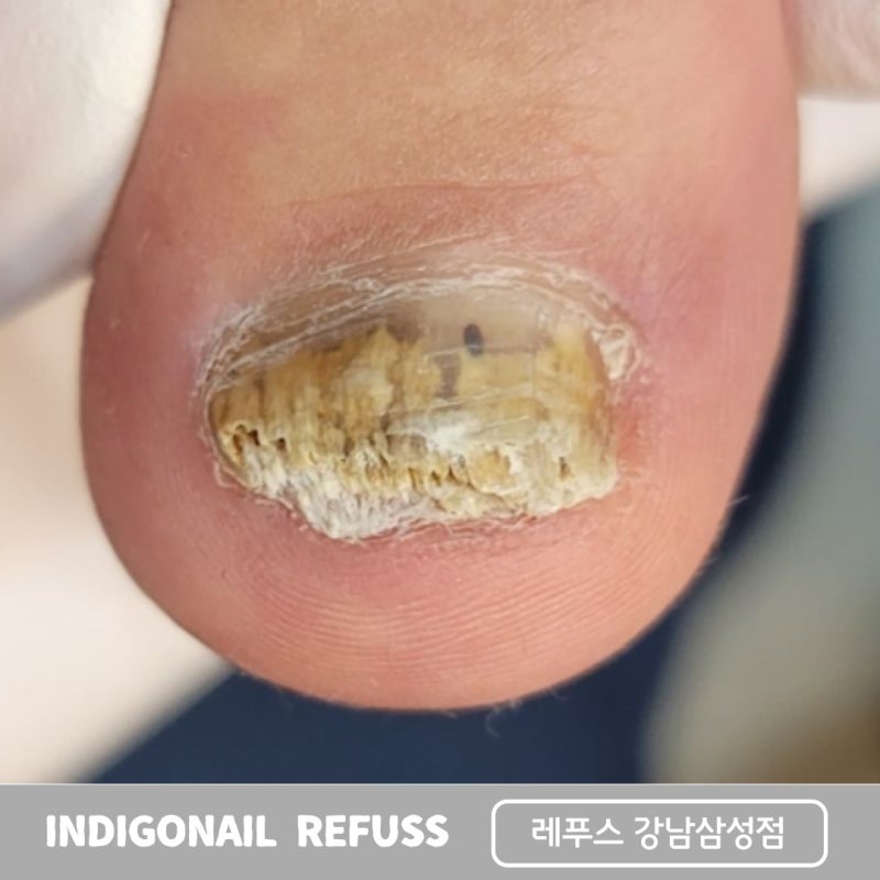 강남 발톱, 기본 솔루션