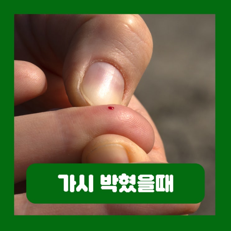  손에 발에 가시 박혔을때 피부과 제거 안 빼고 냅두면 깊게