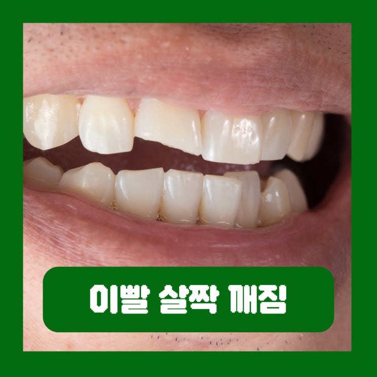  이빨 살짝 깨짐 깨진 치아 대처 치료