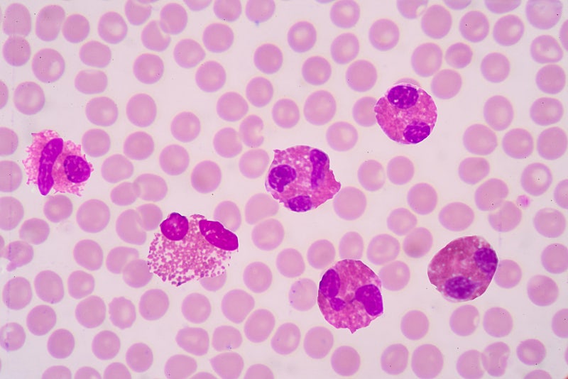 eosinophilia
