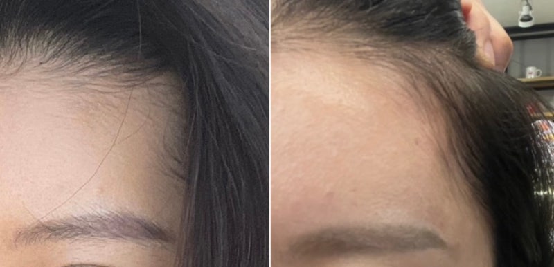 [채정안 헤어 세럼] 리바이탈래쉬 볼륨 인핸싱 폼- M자 탈모 극복 (1년 사용, 두 통째 쓰는 중)