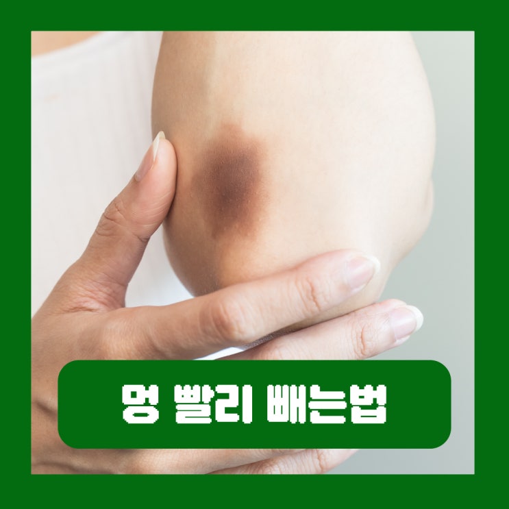  얼굴 멍 빨리 빼는법 눈 쌍수 주사 노란 피멍 드는 이유