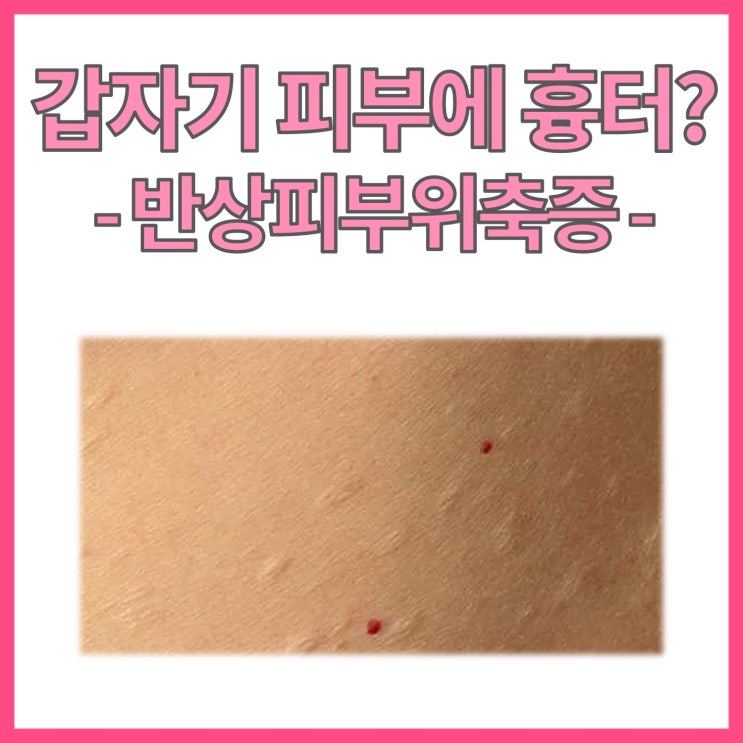  상처도 없었는데 갑자기 흉터가? 반상피부위축증 (Anetoderma)에 대해