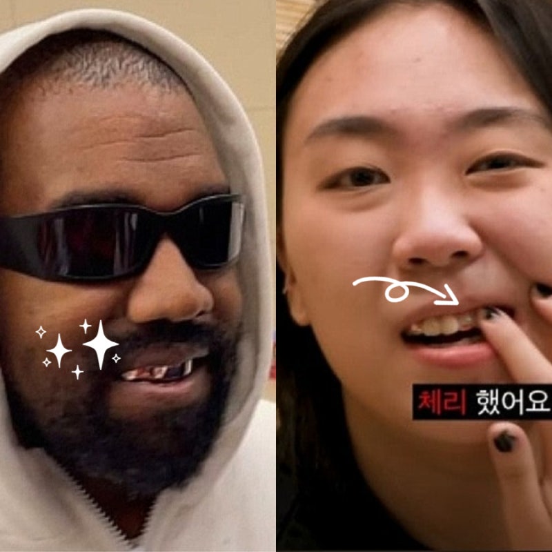칸예 그릴즈 vs 이영지 투스젬 가격 제거 (부작용은 입냄새?)