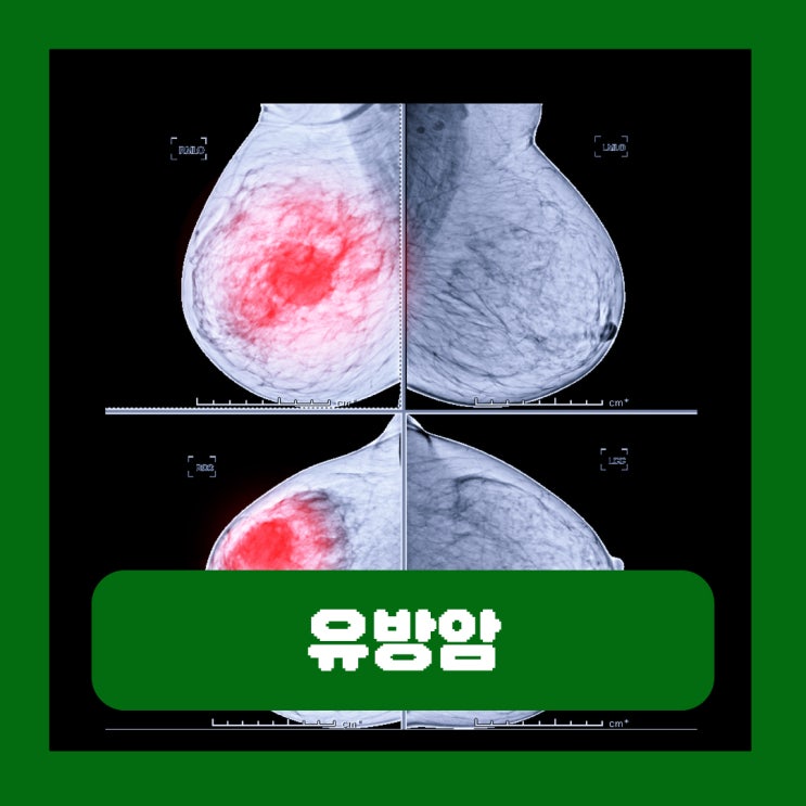  유방암 발생 원인 출산율 피임약 관계 에스트로겐