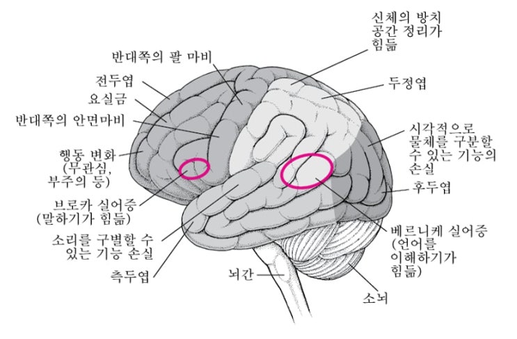 뇌졸중 개요