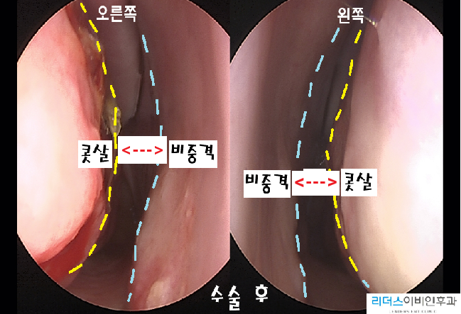 [하비갑개 절제술(고주파소작술)]