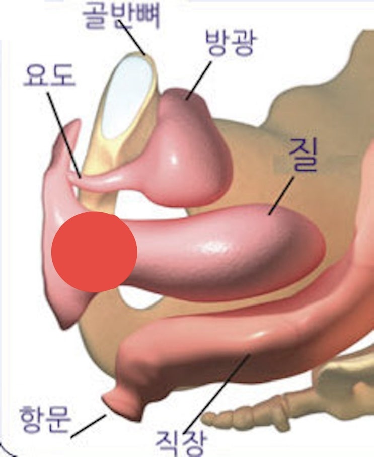  복막 성전환 수술 후 다이레이션 방법