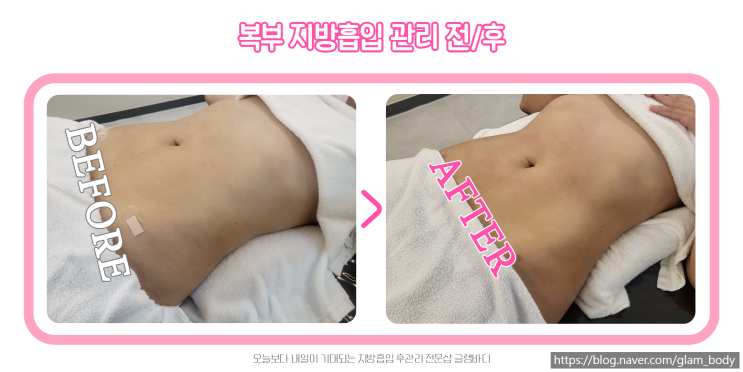  복부지방흡입을 통한 골반이식 솔직한후기