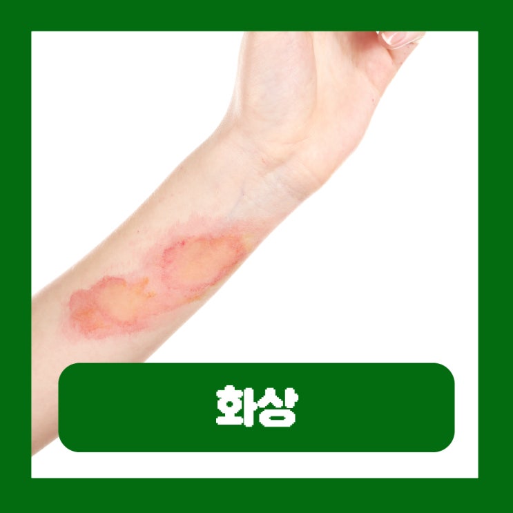  1도화상 응급처치 2도화상 물집 흉터 연고 붕대 병원