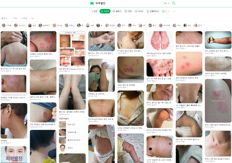 피부발진 치료 화곡동 이목한의원