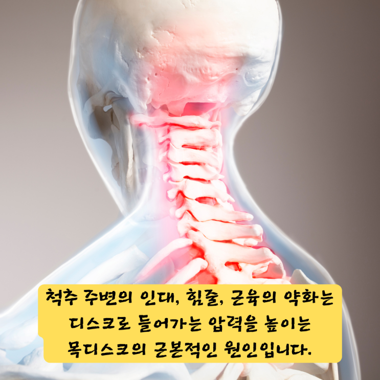  센텀정형외과, 목디스크 수술 고민? '이것'만 알면 비수술로 가능하다.