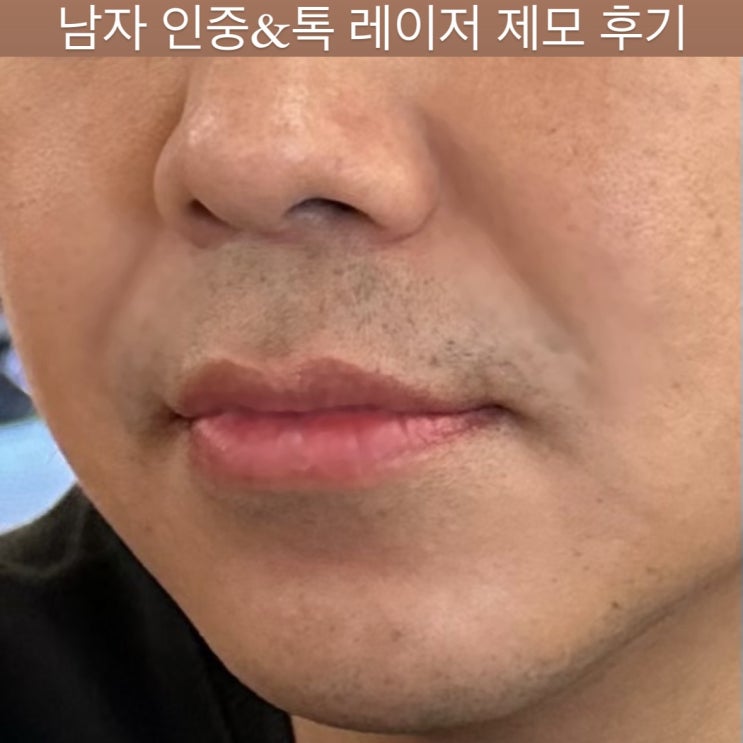  목동 피부과 남자 인중 제모, 레이저 인중 제모 후기, 인중 턱 제모, 가격, 내돈내산