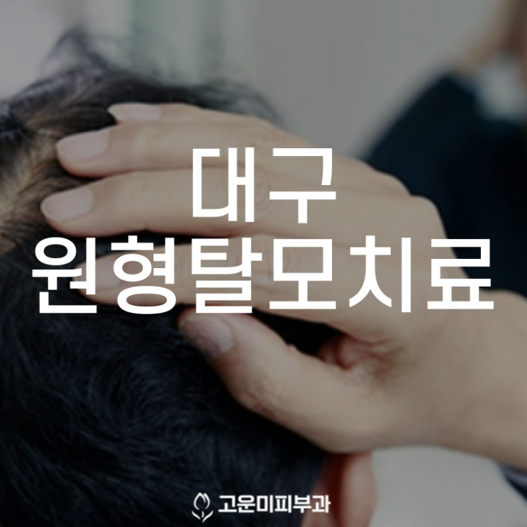  대구탈모치료 방치하면 더 빨리 빠지는 원형탈모 조기 치료가 중요