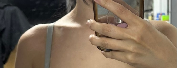  강남역 피부과 승모근 보톡스 한달차 후기 (가격, 통증, 효과)