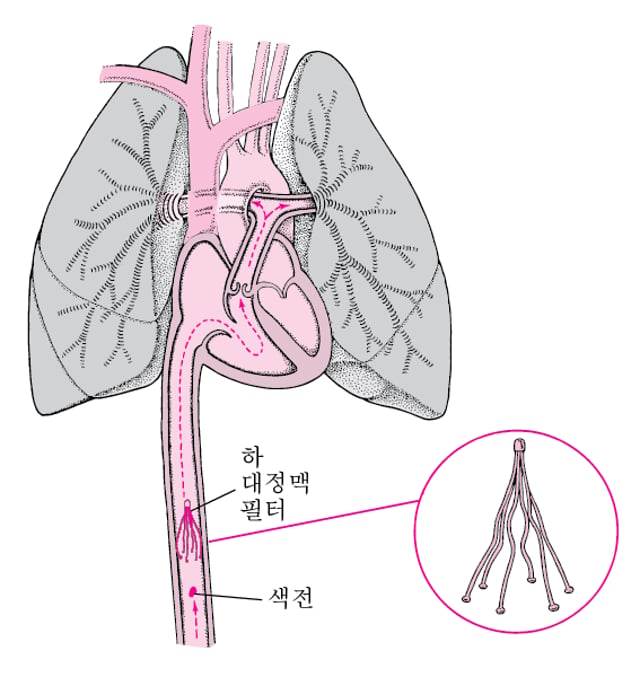 심부정맥 혈전증(DVT)