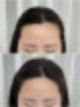 인앤무드 : 하루완성 자연스러운 잠실헤어라인 교정