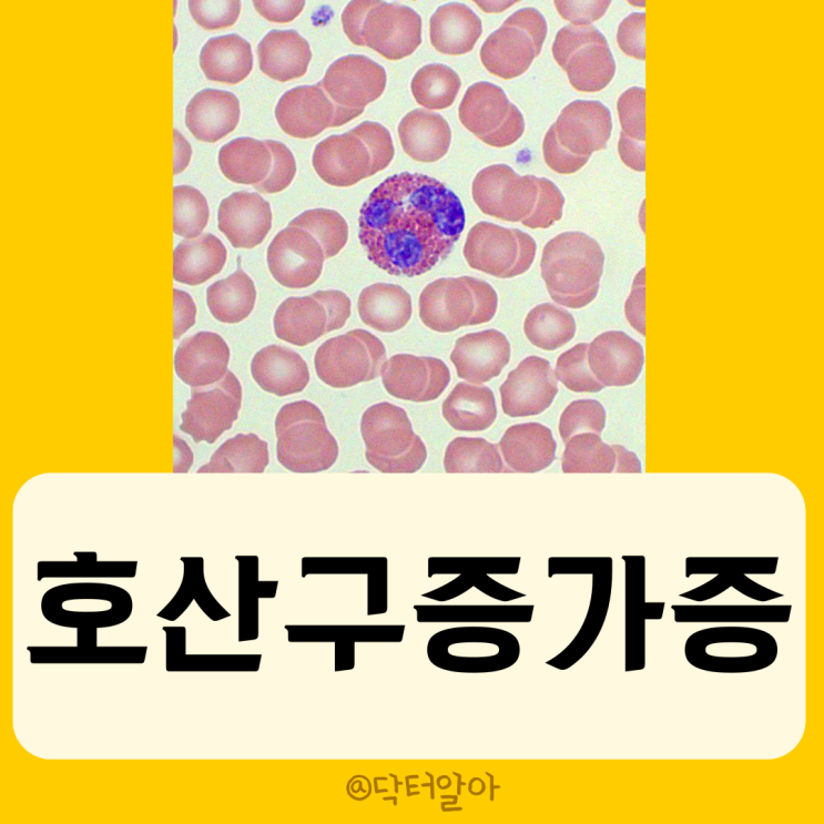  호산구증가증 (Eosinophilia)의 정의, 분류, 진단 및 치료