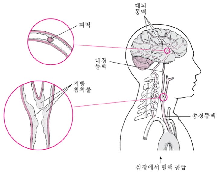 혈관성 치매(혈관성 인지 손상 및 치매)