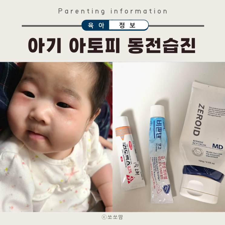  아기아토피와 동전습진의 차이 원인과 증상 치료방법 리도맥스 비판텐 제로이드
