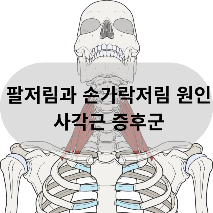  [동래 온천동 목교정] 팔저림과 손가락저림 원인이 되는 사각근 증후군