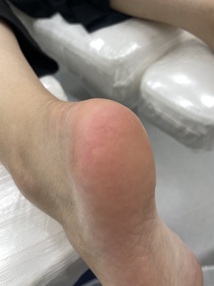  마포발각질제거 하이푸스 마포대흥점 내성발톱 발톱무좀