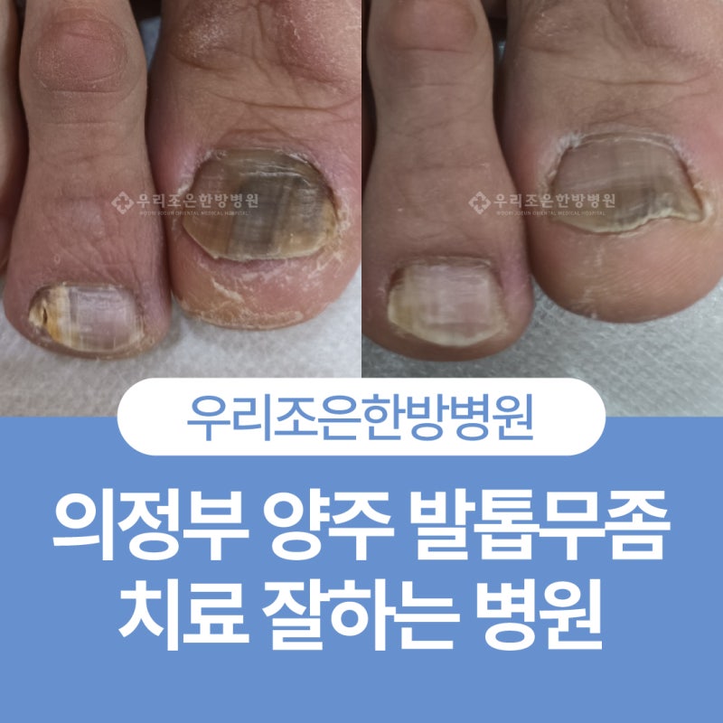 의정부 양주 발톱무좀 치료 잘하는 우리조은한방병원