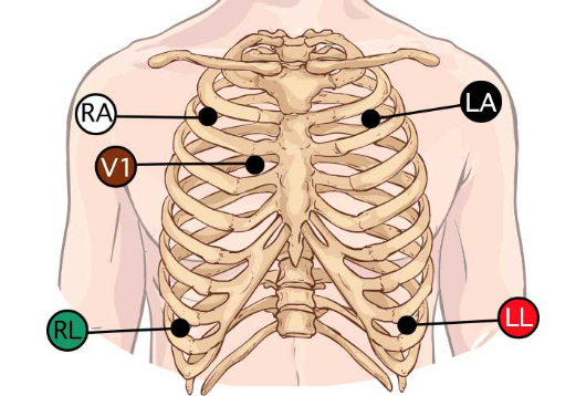 5 lead EKG 부착방법 붙이는방법 : 네이버 블로그