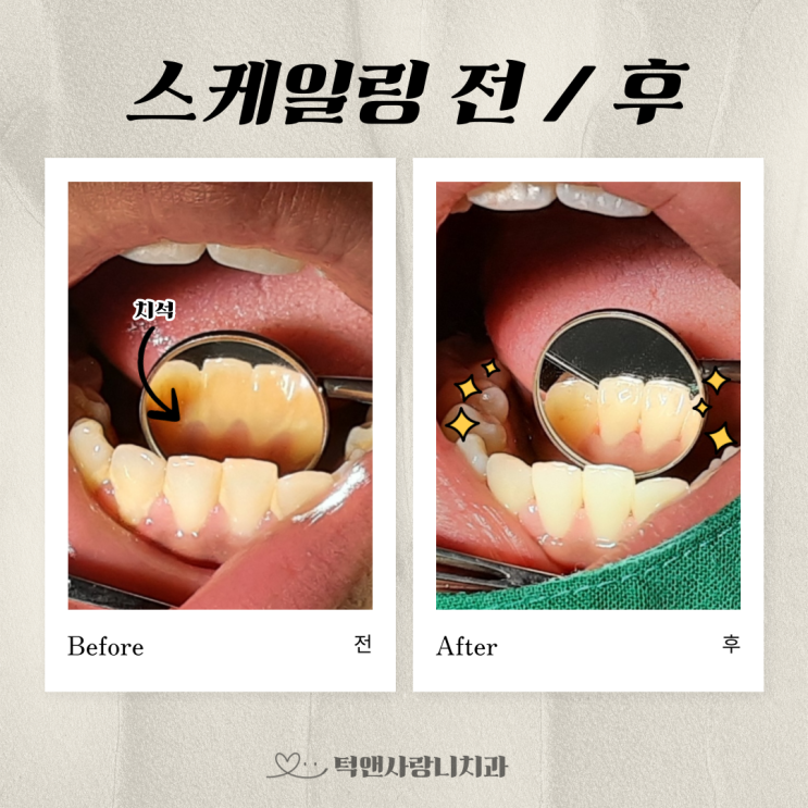  천안 보험 스케일링 치아관리 해주는 치과