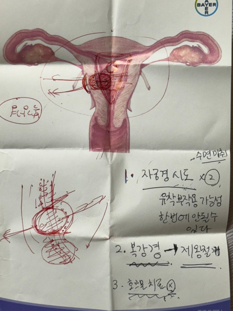 자궁근종 수술후기-1|점막하 자궁근종 증상, 초음파, 수술결심한 이유