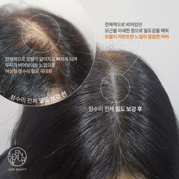  두피문신 잘하는곳 어떤 탈모 증상도 자연스럽게 커버하다