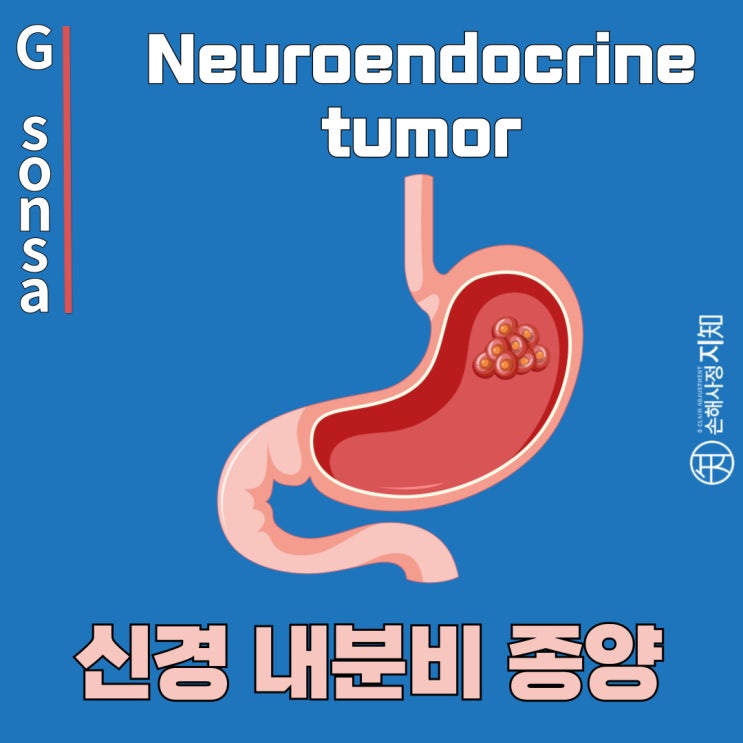  남양주 직장유암종(D37.4) 보험금 청구, 손해사정사의 도움으로 분쟁 해결하기