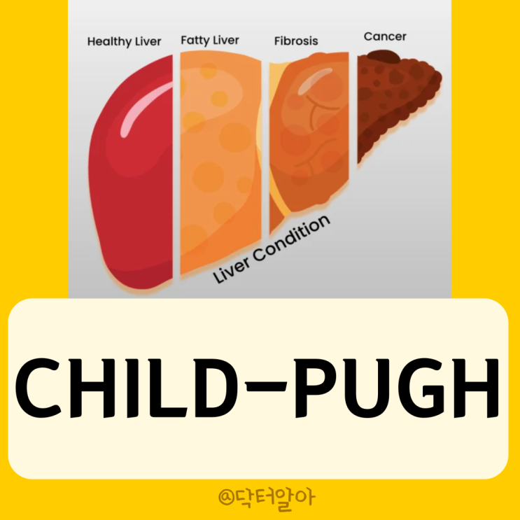  Child-Pugh Score(CTP score)의 정의, 구성 요소, 해석, 한계