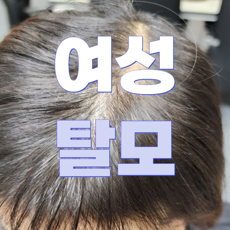  여성 탈모 예방부터 개선까지, 건강한 두피 만드는 꿀팁!