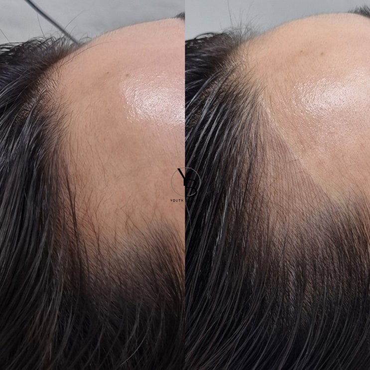  광주헤어라인문신 더 이상 숨기지 말아요..