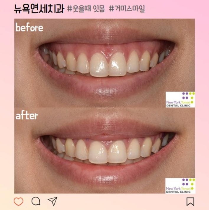  구강전정술 잇몸성형 후기