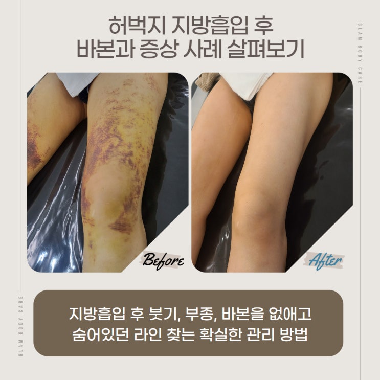  허벅지 지방흡입 바본에 대한 궁금증!