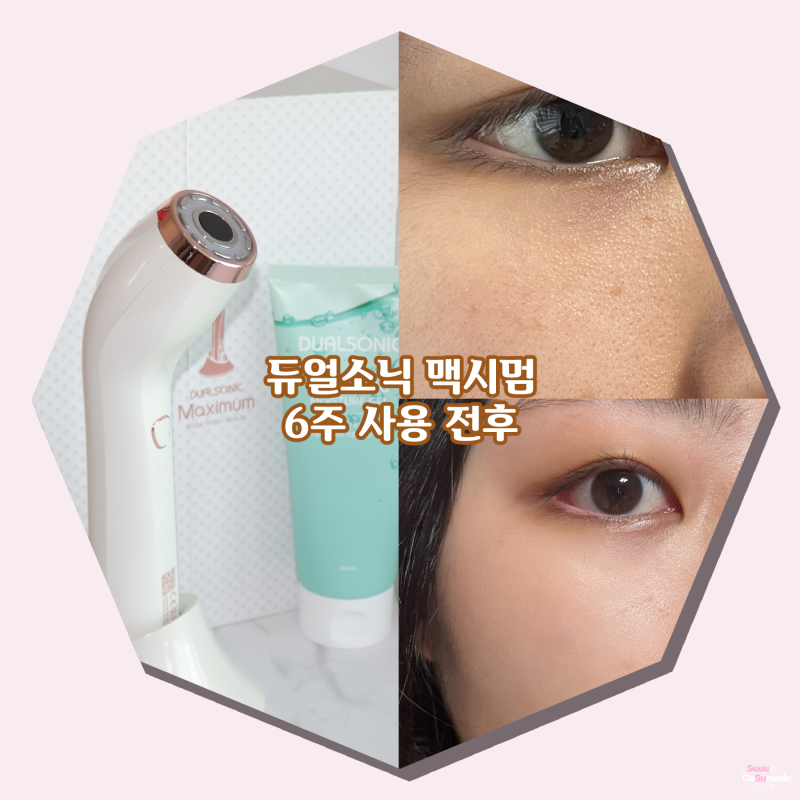듀얼소닉 맥시멈 효과 간증! 6주 사용 전후 후기