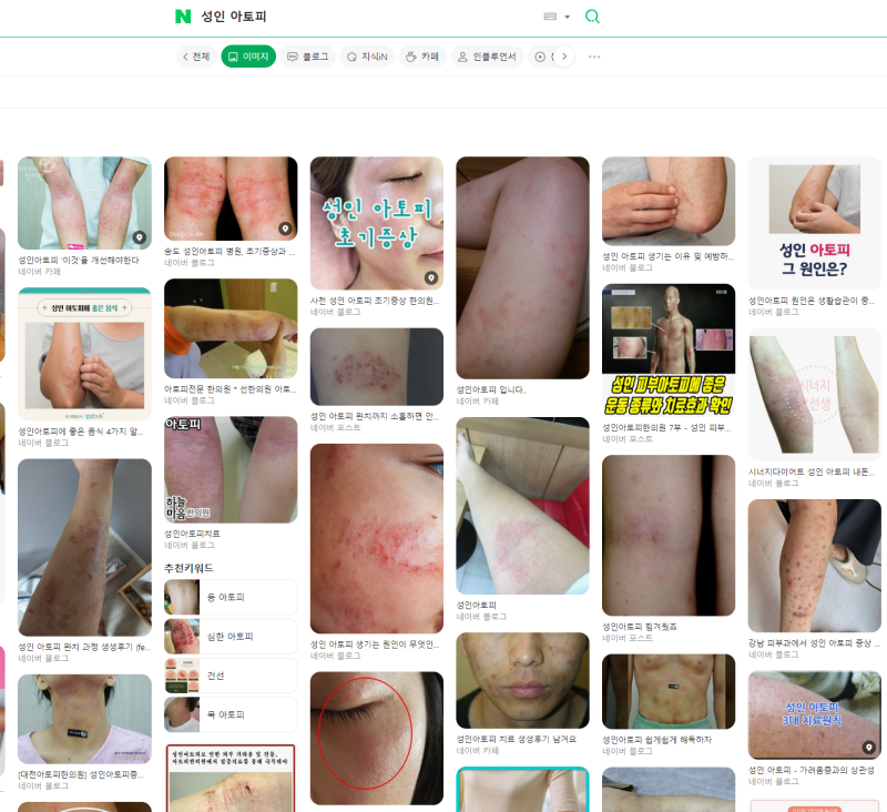 이목한의원 성인아토피 치료