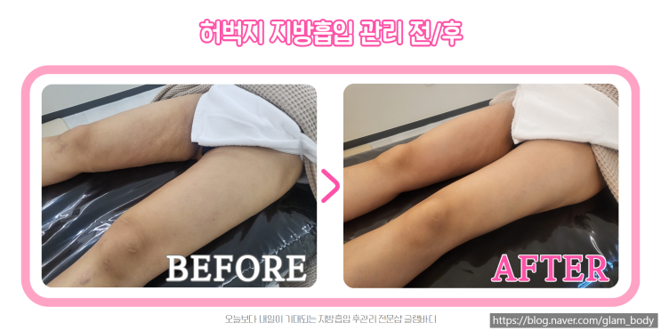 허벅지 안쪽 지방흡입 후 바이오본드관리