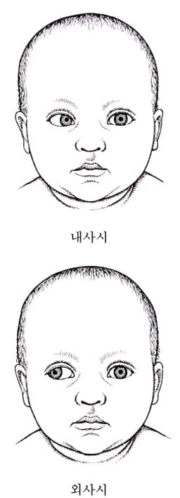 사시(사팔뜨기; 내사시; 외사시)