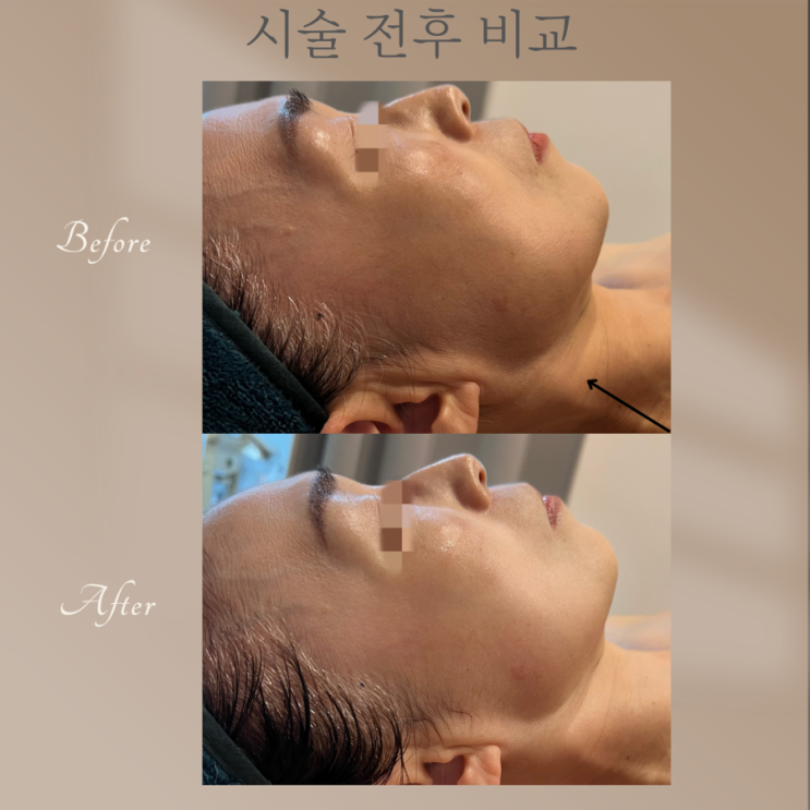  윤곽 리프팅  안면거상 테라피